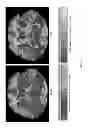 Fig. 17 - SYSTEMS AND METHODS FOR MEASURING LONGITUDINAL BRAIN CHANGE INCORPORATING BOUNDARY-BASED ANALYSIS WITH TENSOR-BASED MORPHOMETRY