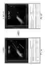 Fig. 10 - PDX1-expressing dorsal and ventral foregut endoderm