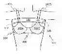 Fig. 01 - Mammography brassiere