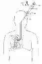 Fig. 01 - DEVICES, METHODS, AND SYSTEMS FOR DELIVERING IMPLANTS TO A LUNG REGION