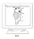 Fig. 10 - Soft tissue cutting instrument and method of use