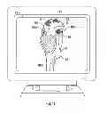 Fig. 11 - Soft tissue cutting instrument and method of use