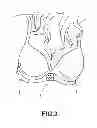 Fig. 04 - E-BRA AND METHODS FOR EARLY DETECTION OF BREAST TUMOR