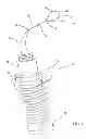 Fig. 02 - Medical retrieval devices