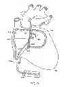 Fig. 08 - SEPTAL PUNCTURE DEVICE
