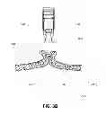 Fig. 11 - METHODS, DEVICES AND SYSTEMS FOR APPROXIMATION AND FASTENING OF SOFT TISSUE