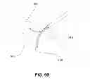 Fig. 13 - METHODS, DEVICES AND SYSTEMS FOR APPROXIMATION AND FASTENING OF SOFT TISSUE