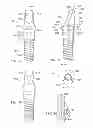 Fig. 13 - Dental restorative system and components