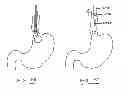 Fig. 24 - Devices and methods for gastrointestinal bypass