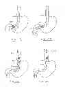 Fig. 47 - Devices and methods for gastrointestinal bypass
