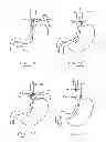 Fig. 48 - Devices and methods for gastrointestinal bypass