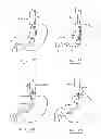 Fig. 50 - Devices and methods for gastrointestinal bypass
