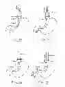 Fig. 52 - Devices and methods for gastrointestinal bypass