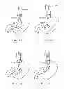 Fig. 53 - Devices and methods for gastrointestinal bypass