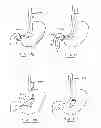 Fig. 49 - Devices and methods for gastrointestinal bypass
