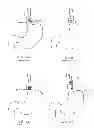 Fig. 20 - Devices and methods for gastrointestinal bypass