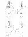 Fig. 23 - Devices and methods for gastrointestinal bypass
