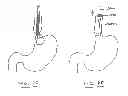 Fig. 24 - Devices and methods for gastrointestinal bypass