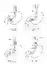 Fig. 47 - Devices and methods for gastrointestinal bypass