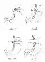 Fig. 48 - Devices and methods for gastrointestinal bypass