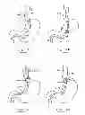 Fig. 50 - Devices and methods for gastrointestinal bypass