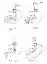 Fig. 53 - Devices and methods for gastrointestinal bypass