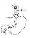 Fig. 01 - DEVICES AND METHODS FOR GASTROINTESTINAL BYPASS