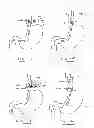 Fig. 49 - DEVICES AND METHODS FOR GASTROINTESTINAL BYPASS