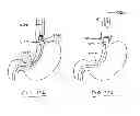 Fig. 52 - DEVICES AND METHODS FOR GASTROINTESTINAL BYPASS