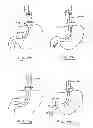 Fig. 53 - DEVICES AND METHODS FOR GASTROINTESTINAL BYPASS