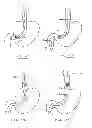 Fig. 48 - Devices and methods for gastrointestinal bypass