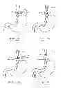 Fig. 49 - Devices and methods for gastrointestinal bypass