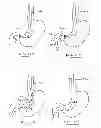 Fig. 50 - Devices and methods for gastrointestinal bypass