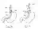Fig. 52 - Devices and methods for gastrointestinal bypass