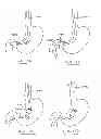 Fig. 49 - Devices and methods for gastrointestinal bypass