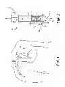 Fig. 02 - Transcutaneous implant tools, systems and methods