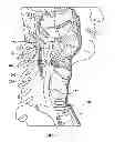 Fig. 02 - Percutaneous methods and devices for carotid body ablation