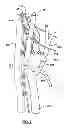 Fig. 03 - Percutaneous methods and devices for carotid body ablation