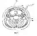 Fig. 08 - Percutaneous methods and devices for carotid body ablation
