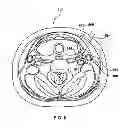 Fig. 09 - Percutaneous methods and devices for carotid body ablation