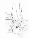 Fig. 22 - Joint arthrodesis and arthroplasty