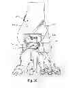 Fig. 35 - Joint arthrodesis and arthroplasty