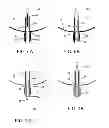 Fig. 05 - Intra-aneurysm devices