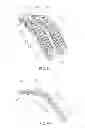 Fig. 06 - Layered soft palate support and implantation method
