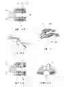 Fig. 10 - Layered soft palate support and implantation method