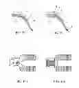 Fig. 11 - Layered soft palate support and implantation method