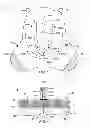Fig. 02 - PERINEUM OVERLAY DEVICE
