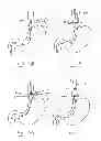 Fig. 49 - Devices and methods for gastrointestinal bypass