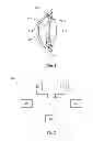 Fig. 02 - Glaucoma drainage devices including vario-stable valves and associated systems and methods