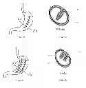 Fig. 04 - Devices for reconfiguring a portion of the gastrointestinal tract